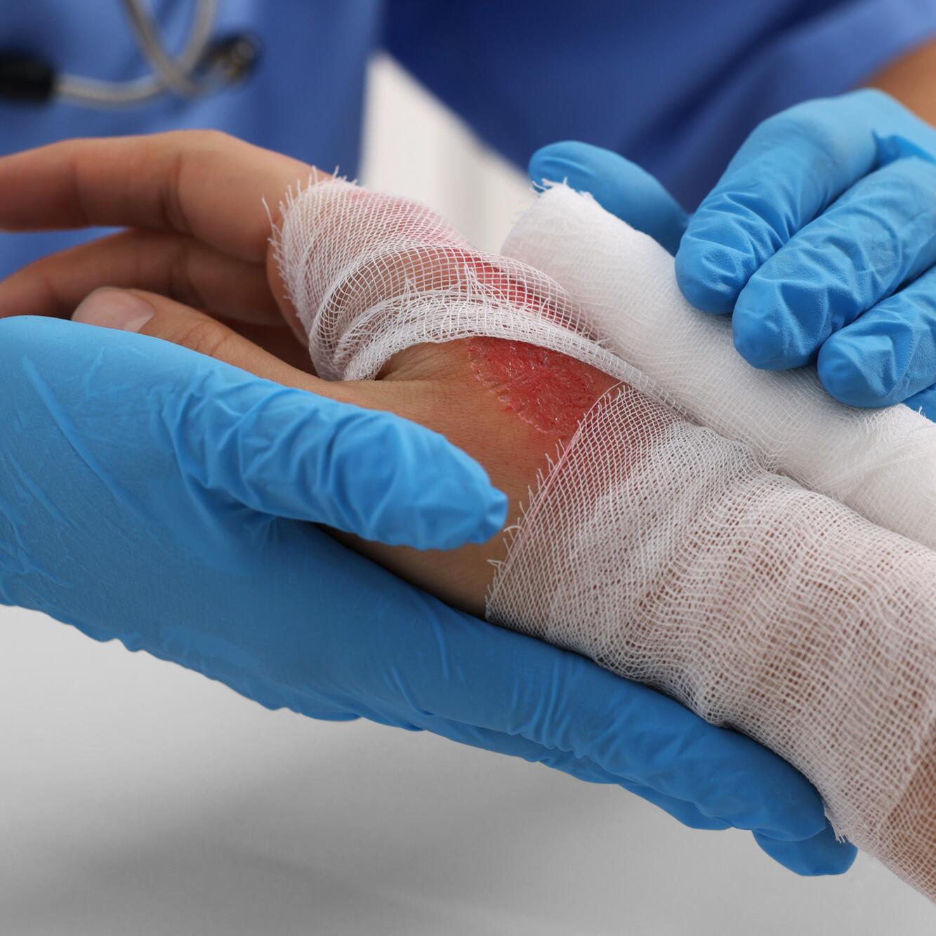 apósito en mano quemada